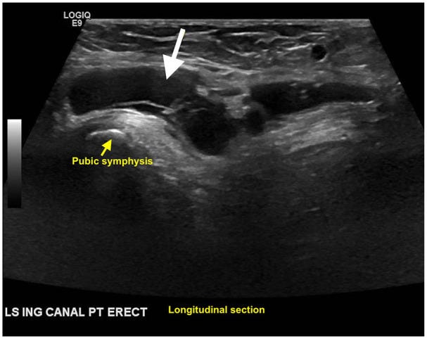 Hernia parte VI Ecografia tempo formacion.jpg